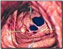 cancer-intestinal.jpg cancer-intestinal.jpg