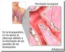 bronquiolitis.jpg