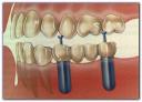 implantes.jpg