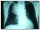 radiografia_cancer_pulmonar2.jpg