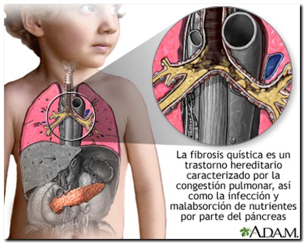 SALUD: Fibrosis quística. Lanzan un nuevo medicamento de fabricación nacional