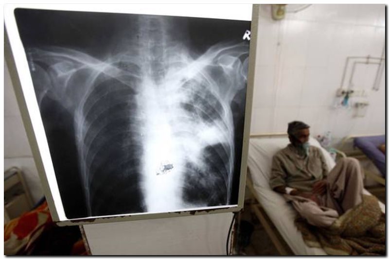 SALUD: La tuberculosis se mantiene letal